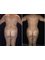 SM Cirugía Plástica - Back liposuction 
