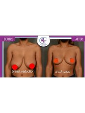 Breast Reduction - Alfayrouz Clinic