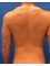 Breast Body Clinic - Back and waist liposuction 