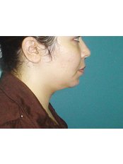 Neck Liposuction - Cairo Plastic Clinic