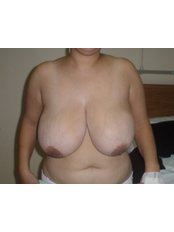 Breast Reduction - Cairo Plastic Clinic