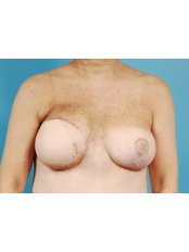 Breast Reconstruction - Cairo Plastic Clinic