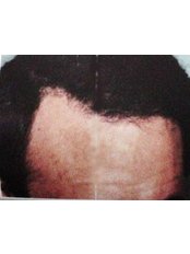 Hair Transplant - Cairo Plastic Clinic