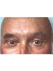 Eyelid Surgery - Cairo Plastic Clinic
