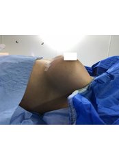 Breast Implants - Change Me Clinic