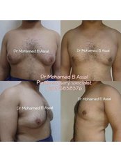 Gynecomastia (vaser) men breast reduction - Dr Mohamed El Assal Plastic Surgery Clinic