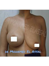 Breast Implants breast augmentation - Dr Mohamed El Assal Plastic Surgery Clinic