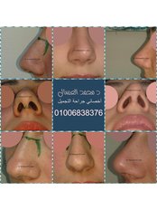Open Rhinoplasty - Dr Mohamed El Assal Plastic Surgery Clinic