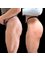 Z Clinic - Buttocks enlargement with Body Fillers 