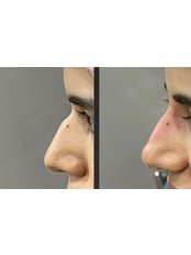 Non-Surgical Nose Job - Z Clinic