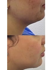 Double Chin Surgery - Z Clinic