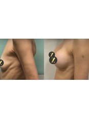 Breast Implants - Z Clinic