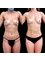 Z Clinic - Female LipoSculpture and Fat Injection in Breasts 
