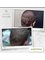 Nour Clinic - Repair of a botched hair transplant that was done somewhere else. We repaired it by doing FUE  