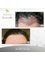 Nour Clinic - FUT hair transplant for wide forehead in women  