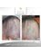 Nour Clinic - SMP (Scalp Micropigmentation) for treatment of scalp scars 