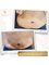 Nour Clinic - After 2 sessions of sculpsure device for treatment of extra belly fat  