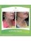 Nour Clinic - Double chin treatment can change your profile view a lot  