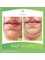 Nour Clinic - Treatment of double chin  