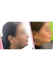 Double Chin Surgery - Dr Rasha Ibrahim Plastic Surgery Clinic
