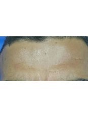 Treatment for Wrinkles - Dr Rasha Ibrahim Plastic Surgery Clinic