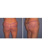 Butt Lift - Dr. Ashraf Abolfotooh Plastic & Reconstructive Surgery Clinic