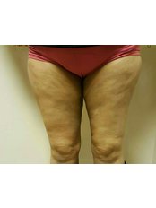 Thigh Liposuction - Dr. Ashraf Abolfotooh Plastic & Reconstructive Surgery Clinic