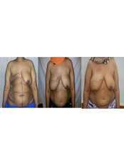 Breast Reconstruction - Dr. Ashraf Abolfotooh Plastic & Reconstructive Surgery Clinic