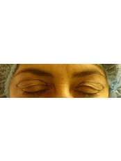 Eyelid surgery - Dr. Ashraf Abolfotooh Plastic & Reconstructive Surgery Clinic