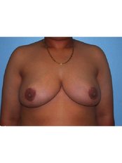 Breast Reduction - Dr. Ashraf Abolfotooh Plastic & Reconstructive Surgery Clinic