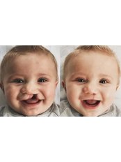 Cleft Lip and Palate Repair - Dr. Fatema Youssef Plastic Surgery Clinic