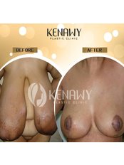 Breast Reduction - Kenawy Plastic Clinic