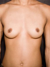 Breast Implants - Docteur Yaël Berdah et Docteur Marc-David Benjoar
