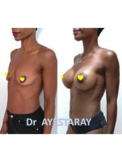 breast augmentation - Dr Benoit AYESTARAY