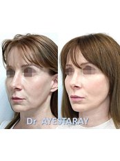face lift - Dr Benoit AYESTARAY