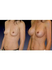 Breast Implants - Dr Sebastiano Montoneri-Cosmetic & Plastic Surgery