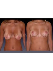 Breast Lift - Dr Sebastiano Montoneri-Cosmetic & Plastic Surgery