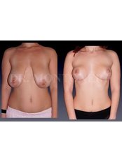 Breast Reduction - Dr Sebastiano Montoneri-Cosmetic & Plastic Surgery
