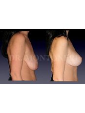 Breast Lift - Dr Sebastiano Montoneri-Cosmetic & Plastic Surgery