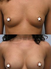Breast Augmentation - Medi-in-op