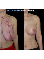 Breast Lift - Hatzipieras Plastic Surgery