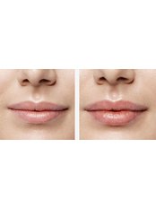 Lip Augmentation - Hatzipieras Plastic Surgery
