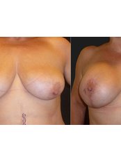 Breast Lift - Opsis Clinical - Athens