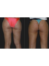 Thigh Lift - Opsis Clinical - Athens