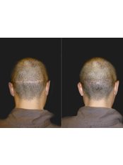 Hair Transplant - Opsis Clinical - Athens