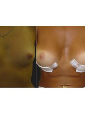 Breast Augmentation - Opsis Clinical - Athens