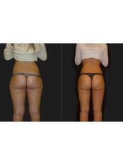 Liposuction - Opsis Clinical - Athens