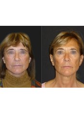 Brow Lift - Opsis Clinical - Athens