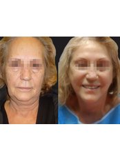 Facelift - Opsis Clinical - Athens