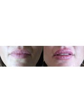Dermal Fillers - Opsis Clinical - Athens
